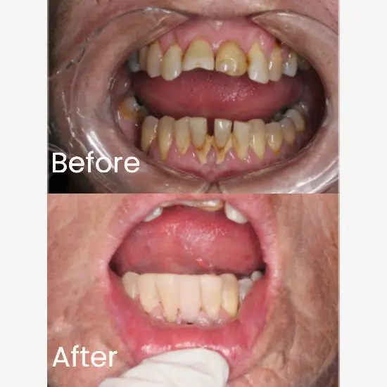 Resin Bonded Bridges Case 1