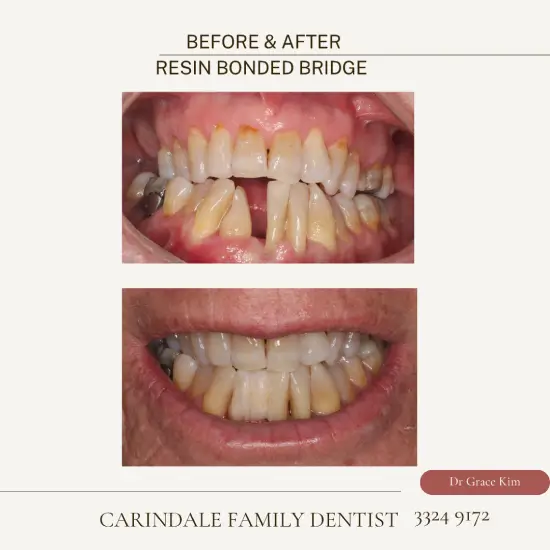 Resin Bonded Bridges Case 2