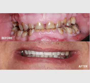 Smile Makeover Case 13