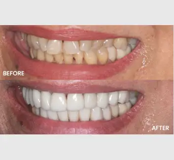 Smile Makeover Case 14