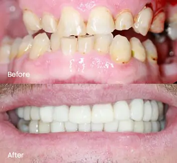 Smile Makeover Case 17