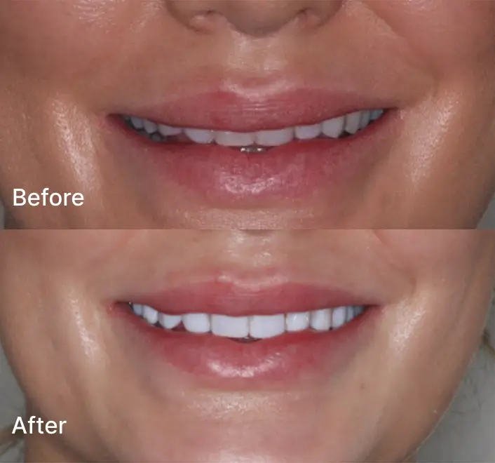 Smile Makeover Case 2