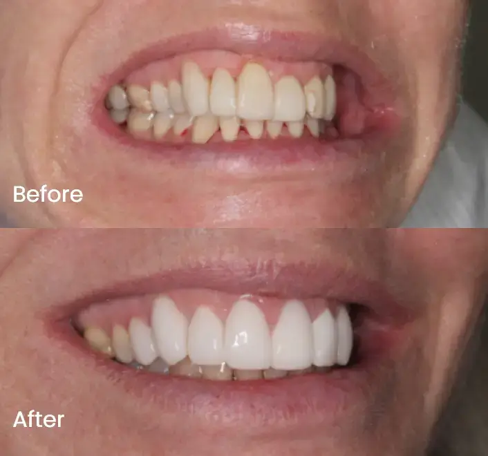 Smile Makeover Case 3