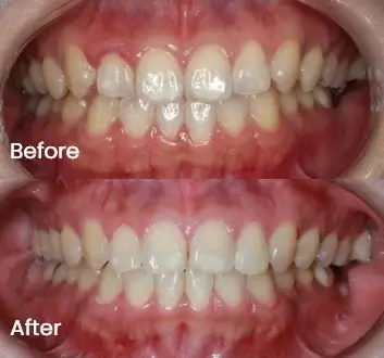 Before and after close-up comparison of teeth