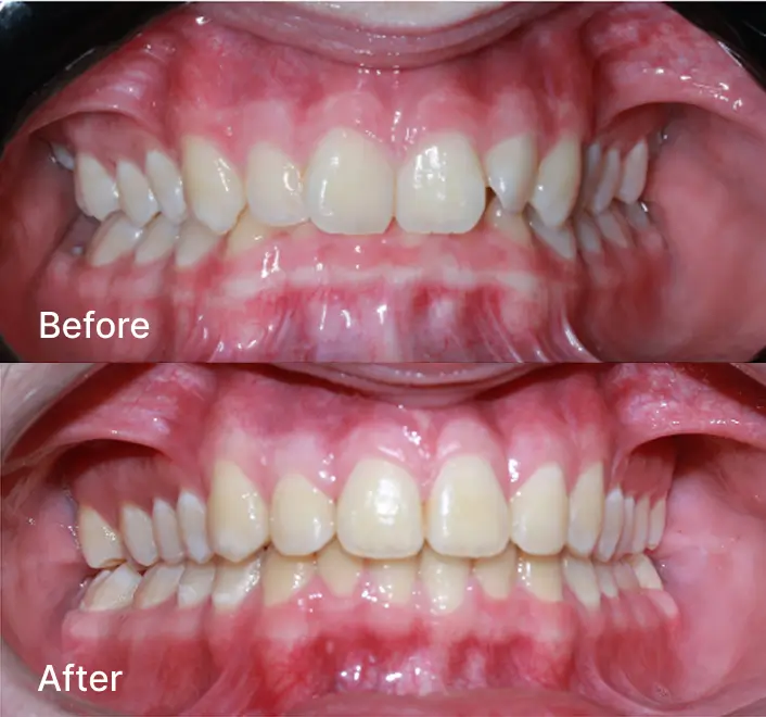 Before and after teeth alignment comparison
