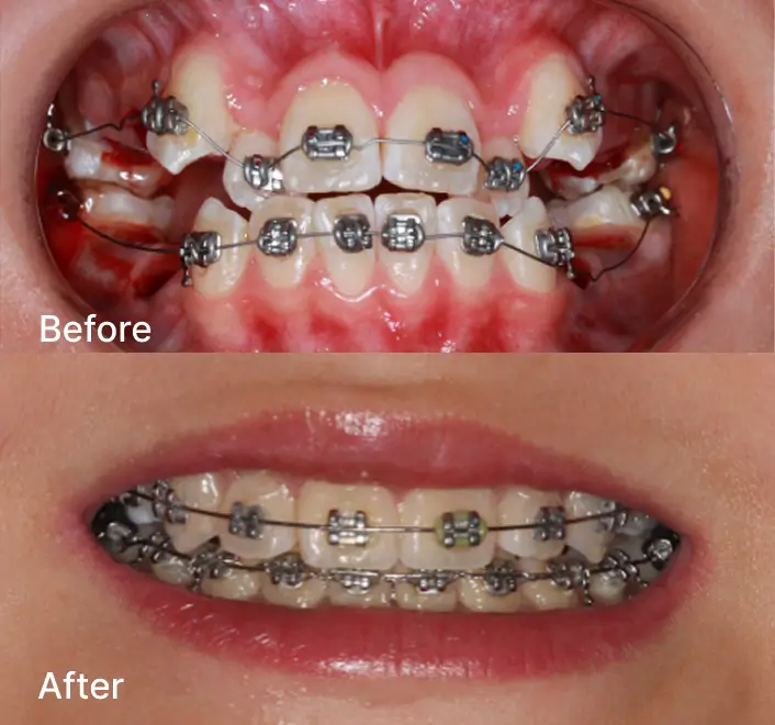Before and after views of teeth with braces