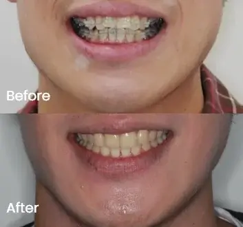 Before and after close-up of tooth alignment