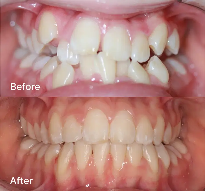 Before and after views showing changes in tooth positioning