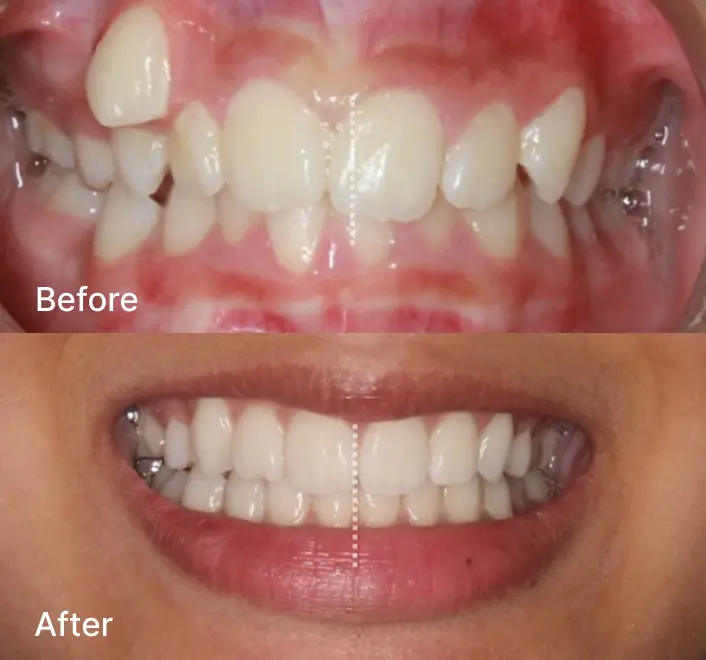 Before and after views showing uneven tooth positioning