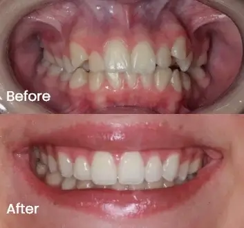 Before and after comparison of upper and lower teeth