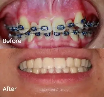 Orthodontics Case 44