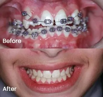 Orthodontics Case 22