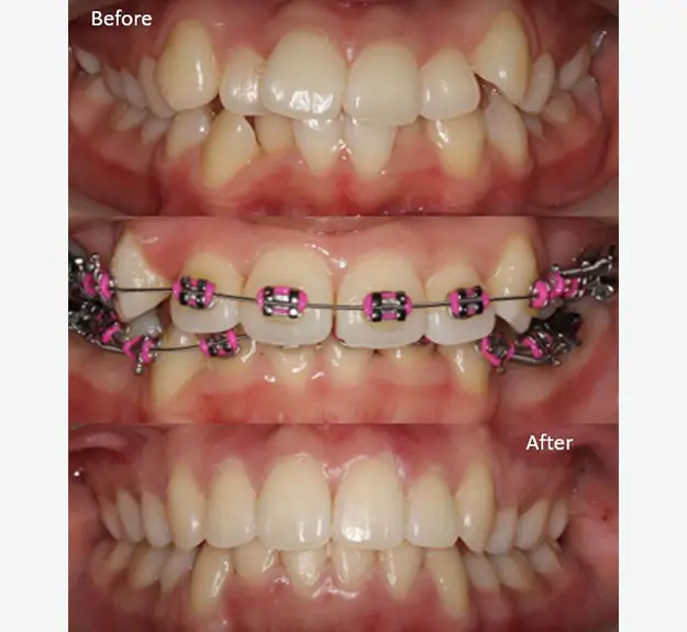 Orthodontics Case 30