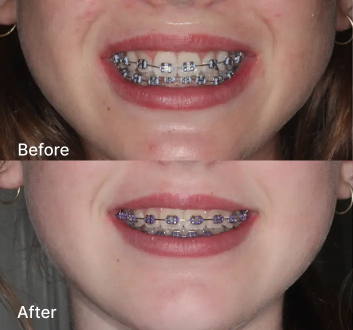 Smile comparison showing braces