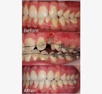 Orthodontics Case 28