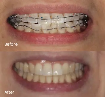 Orthodontics Case 38