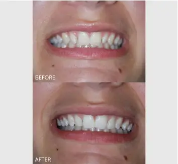 Smile Makeover Case 16