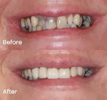 Smile Makeover Case 21
