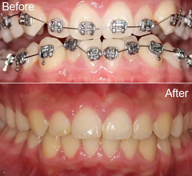Orthodontics Case 29