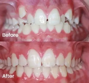 Orthodontics Case 21