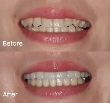 Smile Makeover Case 19