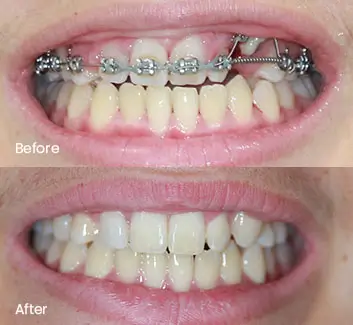 Orthodontics Case 34