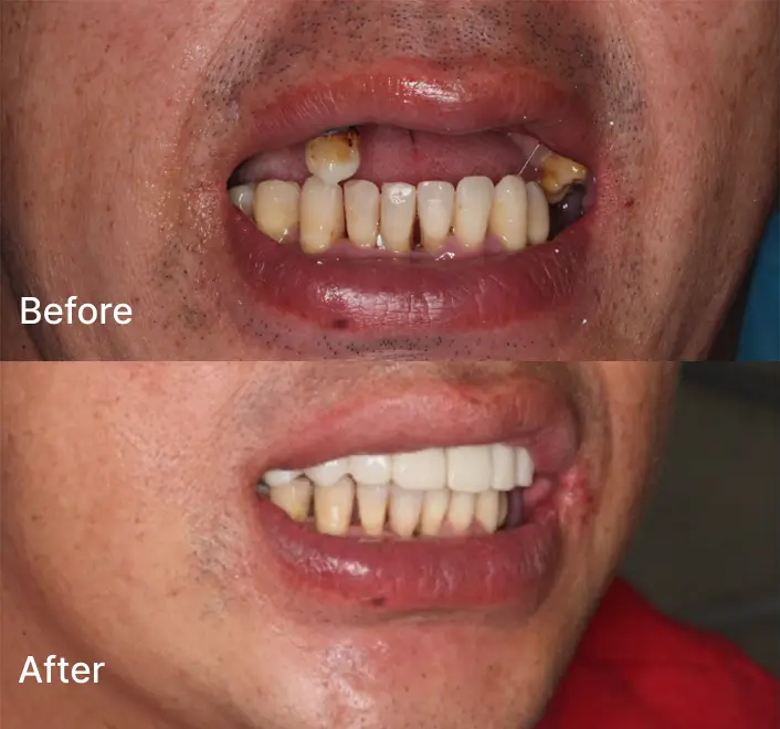 Replacing Missing Teeth Case