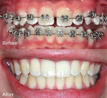 Orthodontics Case 32