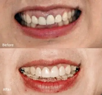 Gummy Smile Treatment Case 5
