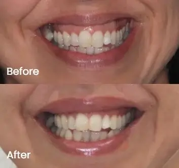 Gummy Smile Treatment Case 3