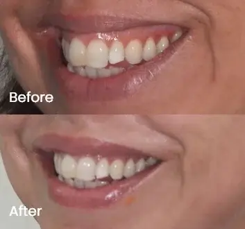 Gummy Smile Treatment Case 2