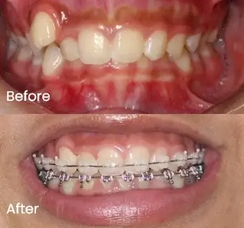 Orthodontics Case 46