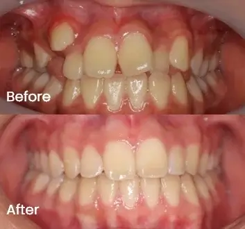Orthodontics Case 23