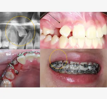 Orthodontics Case 41