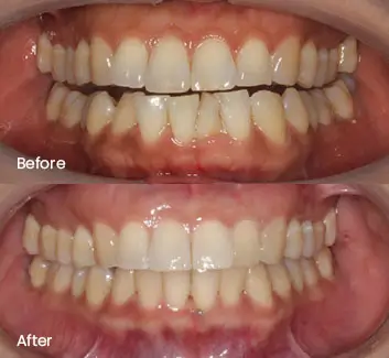 Orthodontics Case 39