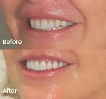 Smile Makeover Case 20