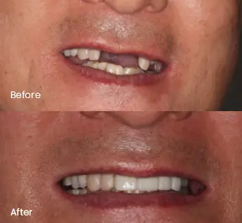 Replacing Missing Teeth Case