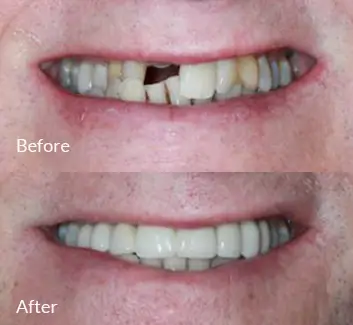 Smile Makeover Case 8