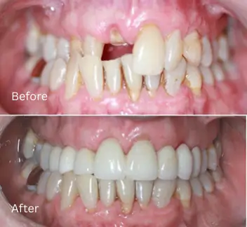 Smile Makeover Case 10