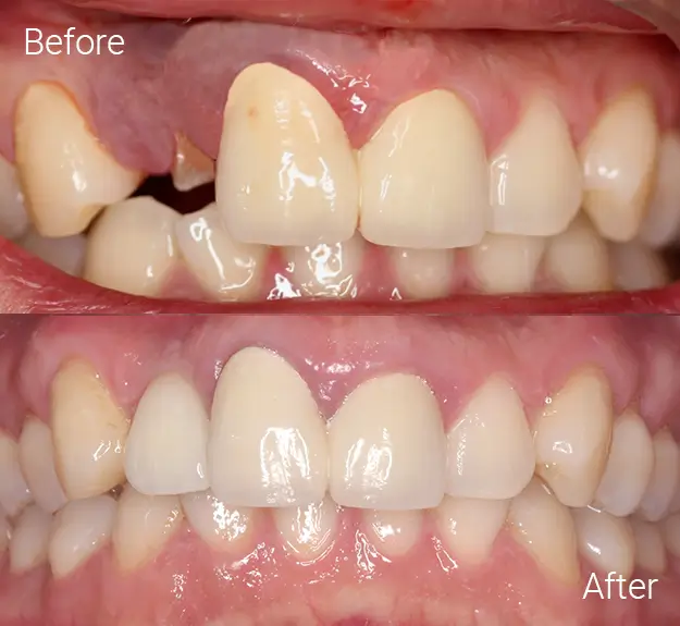 Replacing Missing Teeth Case
