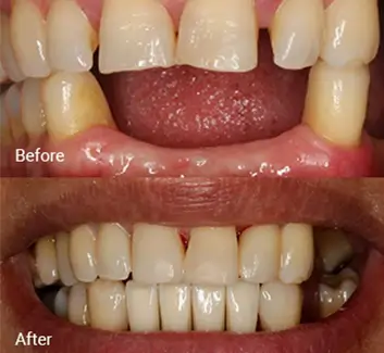 Replacing Missing Teeth Case