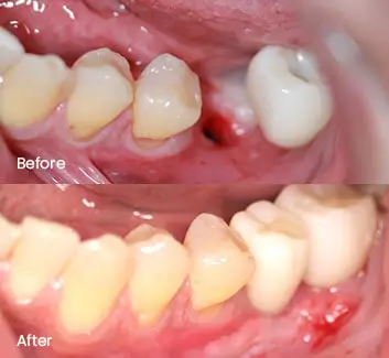 Periodontics Case 1