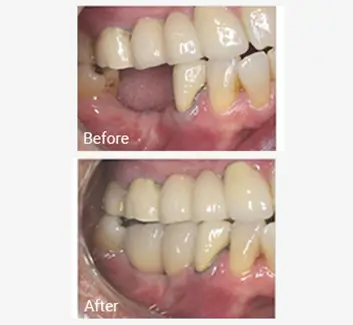 Replacing Missing Teeth Case