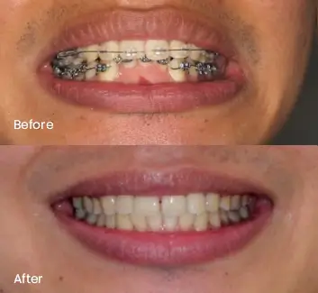 Orthodontics Case 27