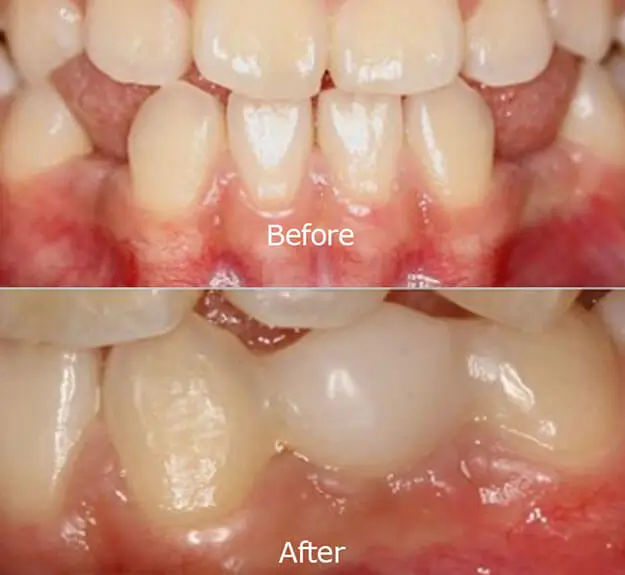 Replacing Missing Teeth Case