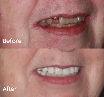 Smile Makeover Case 22