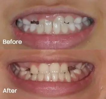 Orthodontics Case 24