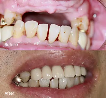 Smile Makeover Case 6