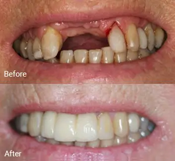 Replacing Missing Teeth Case