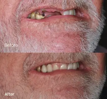 Replacing Missing Teeth Case